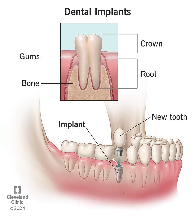 Dental Implantation: Modern Technologies for Restoring a Smile